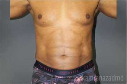 Male Liposuction Before & After Patient #2924