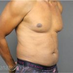 Male Liposuction Before & After Patient #2924