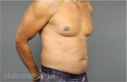 Male Liposuction Before & After Patient #2924