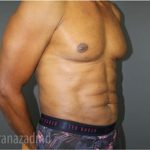 Male Liposuction Before & After Patient #2924