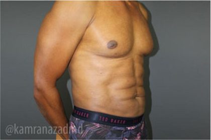Male Liposuction Before & After Patient #2924