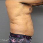 Male Liposuction Before & After Patient #2924