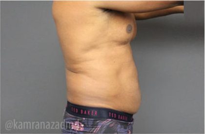 Male Liposuction Before & After Patient #2924