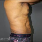 Male Liposuction Before & After Patient #2924