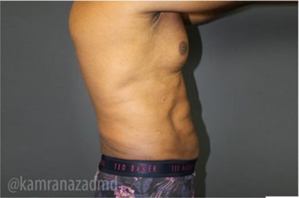 Male Liposuction Before & After Patient #2924
