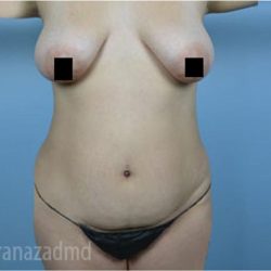 Mommy Makeover Before & After Patient #2918