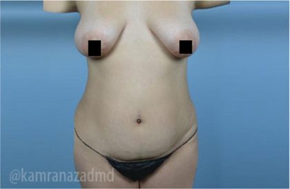Mommy Makeover Before & After Patient #2918