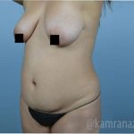 Mommy Makeover Before & After Patient #2918