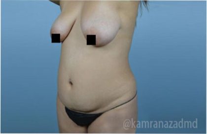 Mommy Makeover Before & After Patient #2918