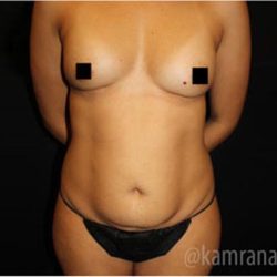 Mommy Makeover Before & After Patient #2909