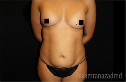 Mommy Makeover Before & After Patient #2909