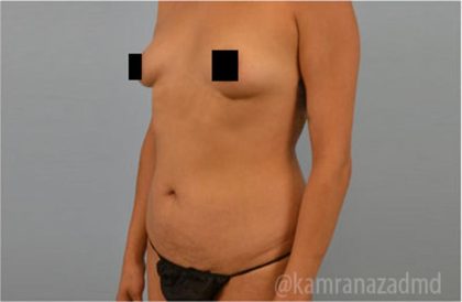 Mommy Makeover Before & After Patient #2910