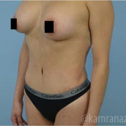 Mommy Makeover Before & After Patient #2910