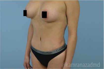 Mommy Makeover Before & After Patient #2910