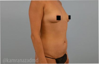 Mommy Makeover Before & After Patient #2910