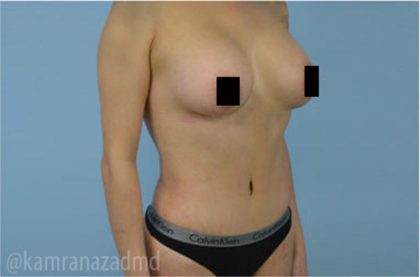 Mommy Makeover Before & After Patient #2910