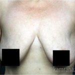 Mommy Makeover Before & After Patient #2911