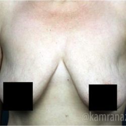 Mommy Makeover Before & After Patient #2911