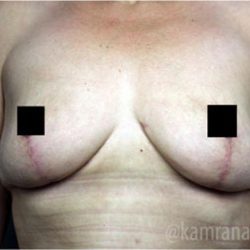 Mommy Makeover Before & After Patient #2911