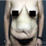 Mommy Makeover Before & After Patient #2911