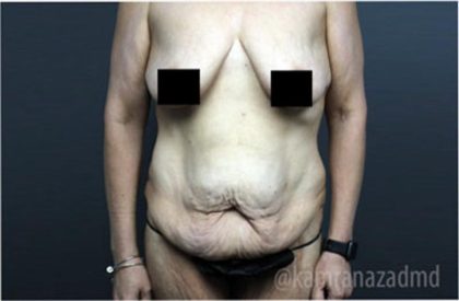 Mommy Makeover Before & After Patient #2911