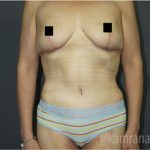 Mommy Makeover Before & After Patient #2911