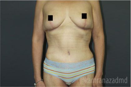 Mommy Makeover Before & After Patient #2911
