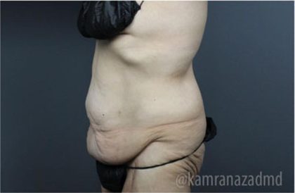 Mommy Makeover Before & After Patient #2911