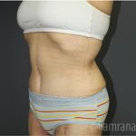 Mommy Makeover Before & After Patient #2911