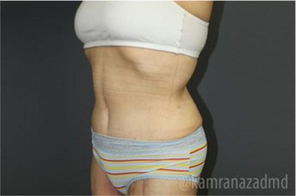 Mommy Makeover Before & After Patient #2911