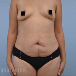 Mommy Makeover Before & After Patient #2912