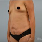 Mommy Makeover Before & After Patient #2912