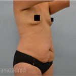 Mommy Makeover Before & After Patient #2912