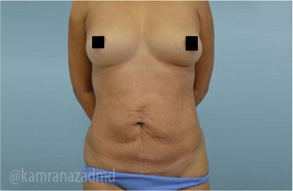 Mommy Makeover Before & After Patient #2913