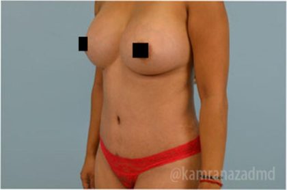Mommy Makeover Before & After Patient #2913