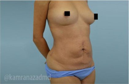 Mommy Makeover Before & After Patient #2913