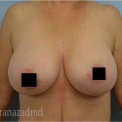 Mommy Makeover Before & After Patient #2914