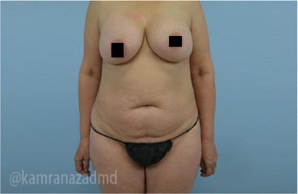 Mommy Makeover Before & After Patient #2914