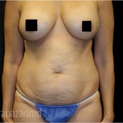 Mommy Makeover Before & After Patient #2915