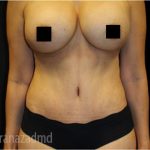 Mommy Makeover Before & After Patient #2915