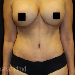 Mommy Makeover Before & After Patient #2915