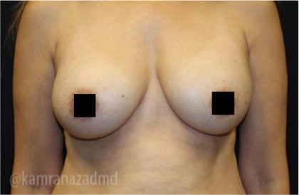 Mommy Makeover Before & After Patient #2915