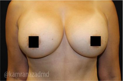 Mommy Makeover Before & After Patient #2915