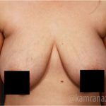 Mommy Makeover Before & After Patient #2916