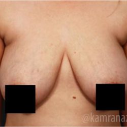Mommy Makeover Before & After Patient #2916