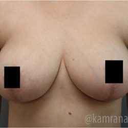 Mommy Makeover Before & After Patient #2916
