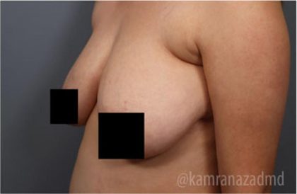Mommy Makeover Before & After Patient #2916