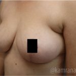 Mommy Makeover Before & After Patient #2916