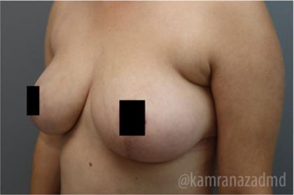 Mommy Makeover Before & After Patient #2916