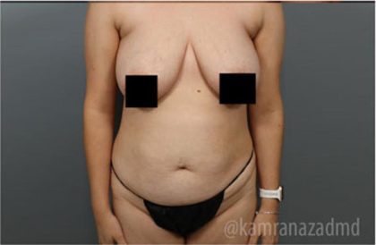 Mommy Makeover Before & After Patient #2916